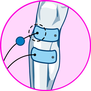 Electrodes for knee