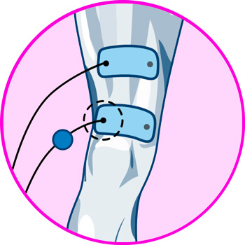 Electrodos para la rodilla